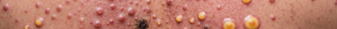 Symptoms and pictures