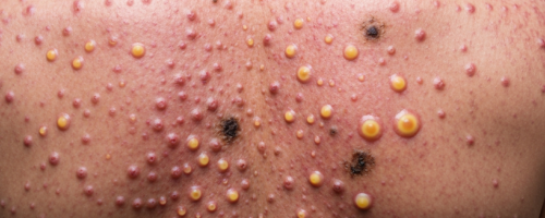 Chickenpox in adults symptoms pictures