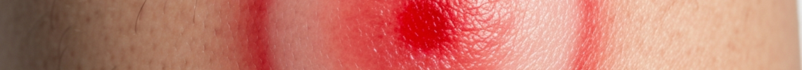 Symptoms and pictures
