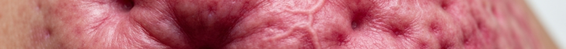 Symptoms and pictures