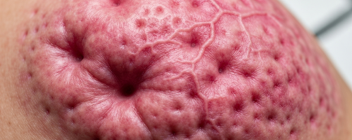 Breast cancer symptoms pictures