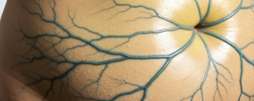 Liver cirrhosis symptoms pictures