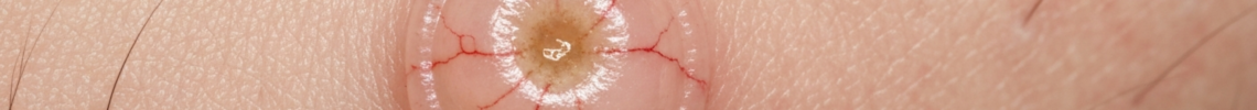 Symptoms and pictures