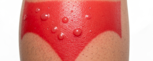 Erysipelas on the leg symptoms pictures