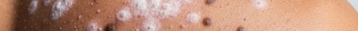 Symptoms and pictures