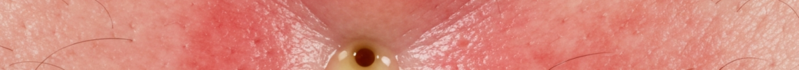 Symptoms and pictures