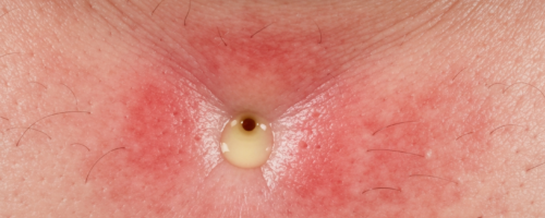 Pulpitis symptoms pictures