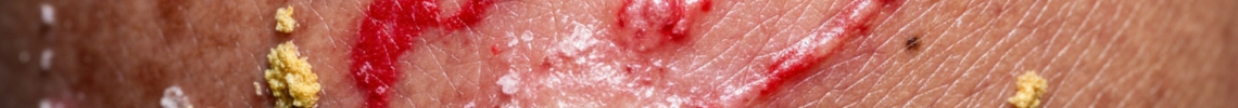 Symptoms and pictures