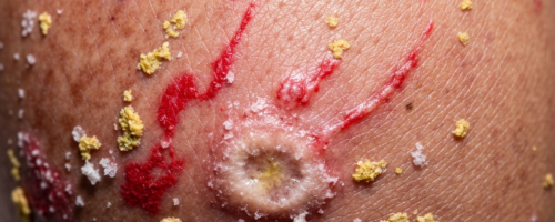 Leg eczema symptoms pictures