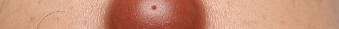 Symptoms and pictures