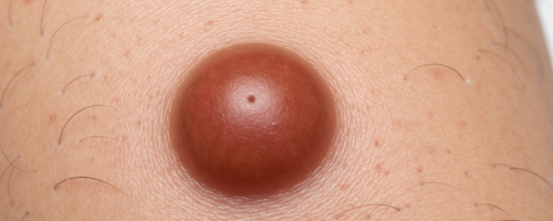 Skin fibroma symptoms pictures
