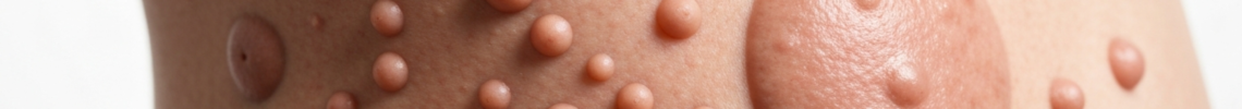 Symptoms and pictures