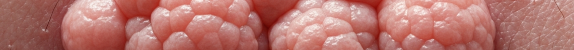 Symptoms and pictures