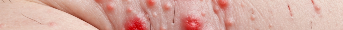 Symptoms and pictures