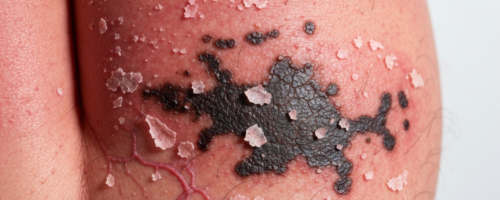 Cervical cancer symptoms pictures