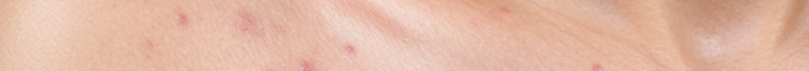 Symptoms and pictures