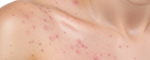 Rubella symptoms pictures