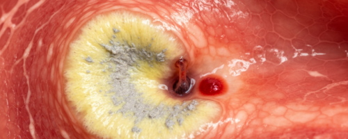 Stomach ulcer symptoms pictures