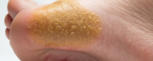 Grade 3 flat feet symptoms pictures