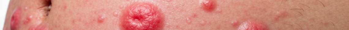 Symptoms and pictures