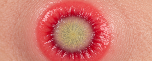 Aphthous stomatitis symptoms pictures