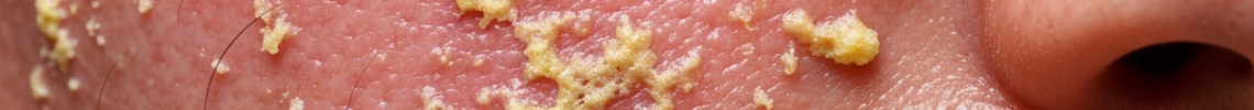 Symptoms and pictures