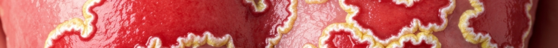 Symptoms and pictures