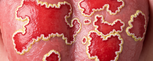 Geographic tongue symptoms pictures