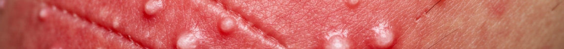 Symptoms and pictures