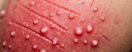 Vulvitis symptoms pictures