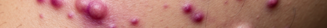 Symptoms and pictures