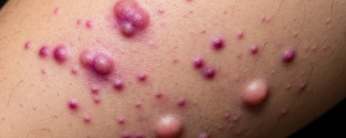 Nasal polyps symptoms pictures