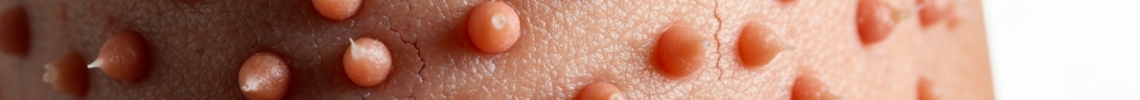Symptoms and pictures