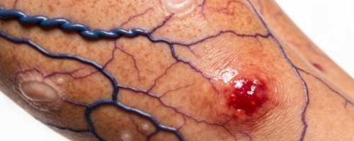 Varicose veins symptoms pictures