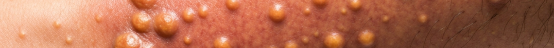 Symptoms and pictures