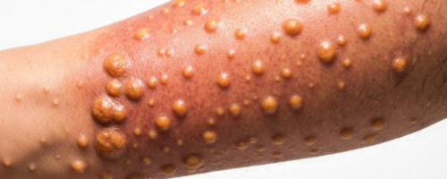 Graves' disease symptoms pictures