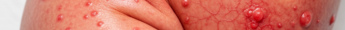 Symptoms and pictures