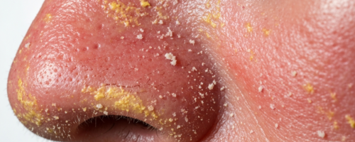 Seborrheic dermatitis on the face symptoms pictures