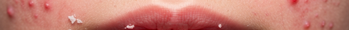 Symptoms and pictures