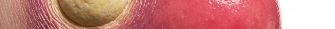 Symptoms and pictures
