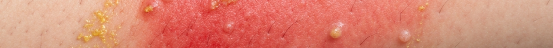 Symptoms and pictures