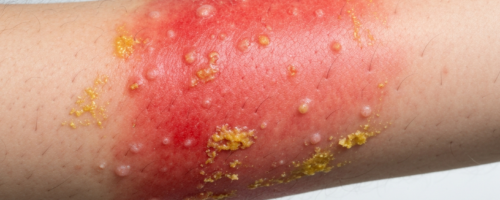 atopic dermatitis in adults symptoms pictures