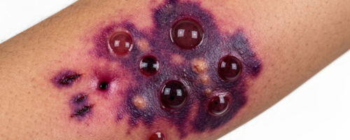 snake bite symptoms pictures
