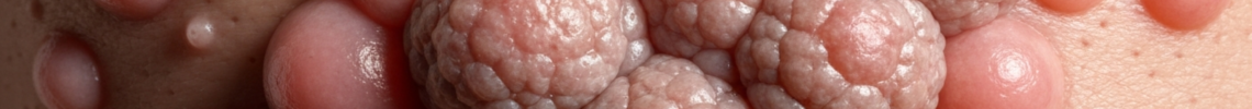 Symptoms and pictures