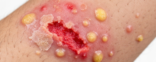 streptoderma in adults symptoms pictures