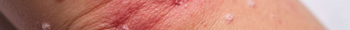 Symptoms and pictures