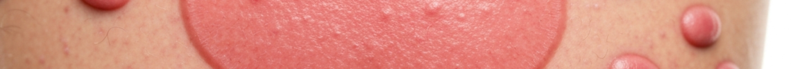 Symptoms and pictures