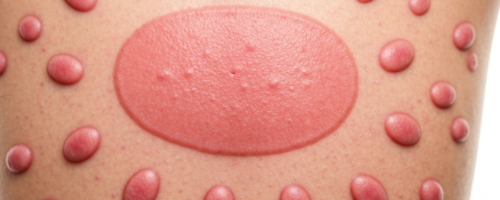lichen rosea symptoms pictures