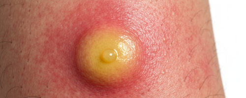 cyst symptoms pictures