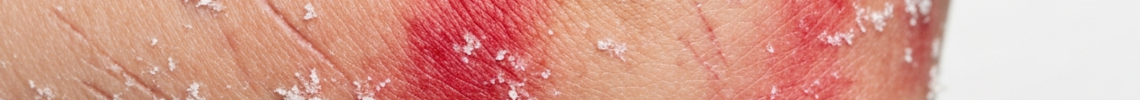 Symptoms and pictures